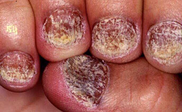 Psoriasis Des Ongles Sur Les Mains Et Les Pieds Causes Diagnostic Et